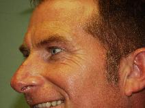 Botulinum Toxin